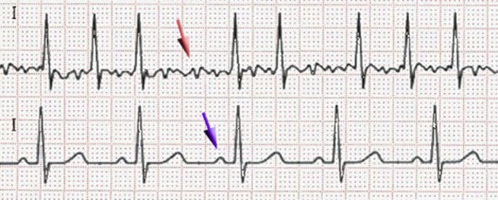 Arritmias cardiacas y embolias