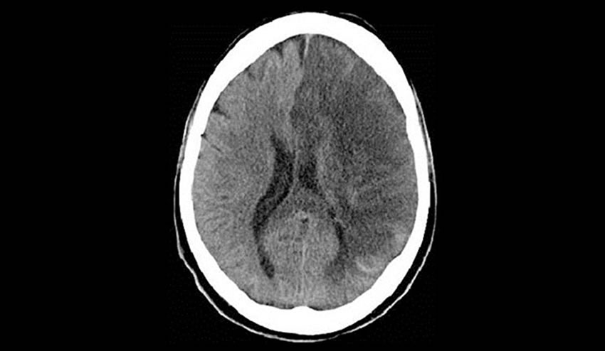 Arritmias cardiacas y embolias