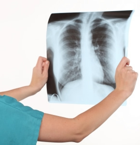 Tuberculosis