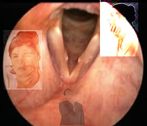 Nódulos de las cuerdas vocales